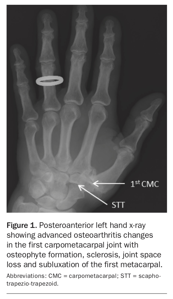 Taking A Grip Of Thumb Osteoarthritis Medicine Today